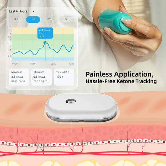 [ Special Bulk Purchase]SiBio KS1 Continuous Ketone Monitoring System (CKM) - SiBio